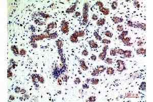 Immunohistochemical analysis of paraffin-embedded human-breast-cancer, antibody was diluted at 1:200 (BMP2 antibody  (C-Term))