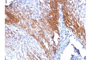 Formalin-fixed, paraffin-embedded human Cervical Carcinoma stained with CK17 Mouse Monoclonal Antibody (KRT17/778). (KRT17 antibody)