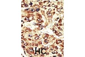 Formalin-fixed and paraffin-embedded human cancer tissue reacted with the primary antibody, which was peroxidase-conjugated to the secondary antibody, followed by AEC staining. (WEE1 antibody  (C-Term))