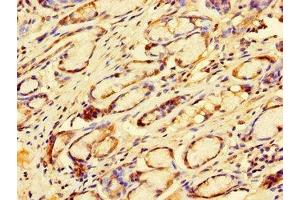 Immunohistochemistry of paraffin-embedded human gastric cancer using ABIN7172505 at dilution of 1:100 (DP2 antibody  (AA 344-386))