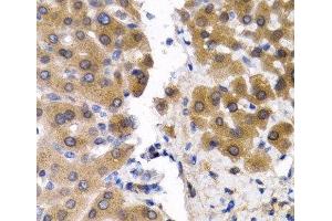 Immunohistochemistry of paraffin-embedded Human liver cancer using SCP2 Polyclonal Antibody at dilution of 1:200 (40x lens). (SCP2 antibody)