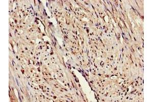 Immunohistochemistry of paraffin-embedded human endometrial cancer using ABIN7151655 at dilution of 1:100 (ERAP1 antibody  (AA 642-941))