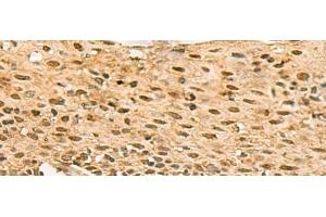 Immunohistochemistry of paraffin-embedded Human cervical cancer tissue using SCMH1 Polyclonal Antibody at dilution of 1:120(x200) (SCMH1 antibody)