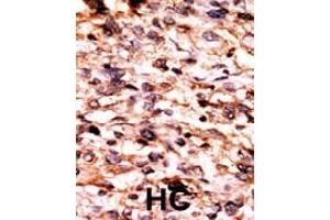 Formalin-fixed and paraffin-embedded human hepatocellular carcinoma tissue reacted with CREB1 (phospho S133) polyclonal antibody  which was peroxidase-conjugated to the secondary antibody followed by AEC staining. (CREB1 antibody  (pSer133))