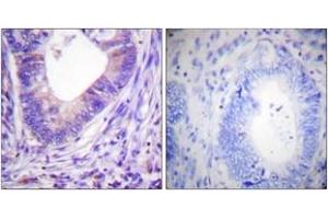 Immunohistochemistry analysis of paraffin-embedded human colon carcinoma tissue, using PKA alpha/beta CAT (Ab-197) Antibody. (PKA alpha/beta Cat (AA 166-215) antibody)