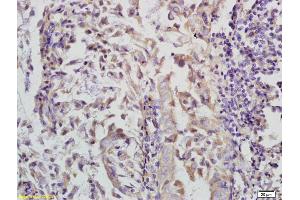 Formalin-fixed and paraffin embedded human colon carcinoma labeled with Anti-Phospho-FoxO3a (Ser253) Polyclonal Antibody, Unconjugated (ABIN684718) at 1:200 followed by conjugation to the secondary antibody (FOXO3 antibody  (pSer253))