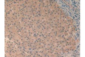 IHC-P analysis of Human Liver Cancer Tissue, with DAB staining. (RELB antibody  (AA 248-492))