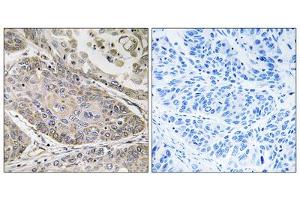Immunohistochemistry analysis of paraffin-embedded human lung carcinoma tissue using PLA2G4E antibody. (PLA2G4E antibody  (Internal Region))