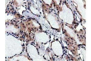 Immunohistochemical staining of paraffin-embedded Carcinoma of Human thyroid tissue using anti-RBBP9 mouse monoclonal antibody. (RBBP9 antibody)