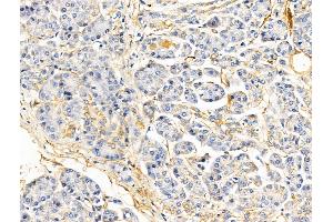 ABIN6260508 and ABIN6268919 at 1/100 staining Human pancreatic cancer and adjacent nomal tissues by IHC-P.