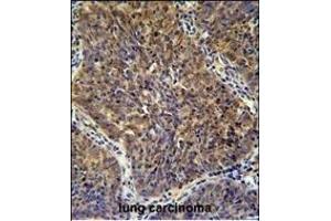 CD2BP2 Antibody (N-term) (ABIN654903 and ABIN2844551) immunohistochemistry analysis in formalin fixed and paraffin embedded human lung carcinoma followed by peroxidase conjugation of the secondary antibody and DAB staining. (CD2BP2 antibody  (N-Term))
