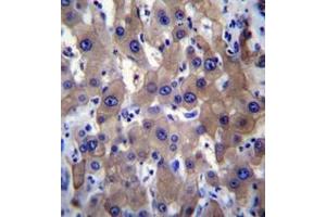 Immunohistochemistry analysis in formalin fixed and paraffin embedded human liver tissue reacted with MLXIPL Antibody (C-term) followed by peroxidase conjugation of the secondary antibody and DAB staining. (MLXIPL antibody  (C-Term))