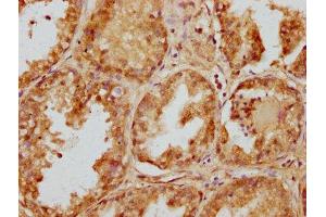 IHC image of ABIN7151970 diluted at 1:200 and staining in paraffin-embedded human prostate cancer performed on a Leica BondTM system. (EDEM1 antibody  (AA 46-128))