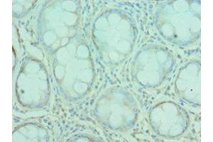 Immunohistochemistry of paraffin-embedded human colon cancer using ABIN7167157 at dilution of 1:100 (G3BP1 antibody  (AA 227-466))
