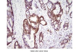 Paraffin embedded sections of human colon canitrocelluloseer tissue were initrocelluloseubated with anti-human HMGB1 (1:200) for 2 hours at room temperature. (HMGB1 antibody  (AA 1-215))