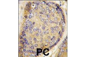 Formalin-fixed and paraffin-embedded human prostata carcinoma tissue reacted with Latexin antibody , which was peroxidase-conjugated to the secondary antibody, followed by DAB staining. (Latexin antibody  (AA 78-107))