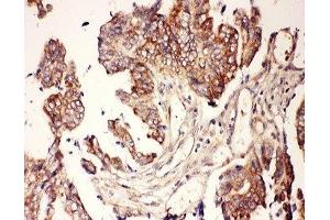 IHC-P: CNTF antibody testing of human intestine cancer tissue (CNTF antibody  (AA 2-200))