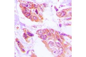 Immunohistochemical analysis of HSPH1 staining in human lung cancer formalin fixed paraffin embedded tissue section. (HSPH1 antibody  (C-Term))