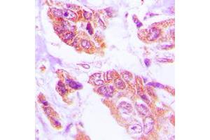 Immunohistochemical analysis of HSPH1 staining in human lung cancer formalin fixed paraffin embedded tissue section.
