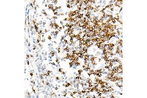 Immunohistochemistry of paraffin-embedded Human Hodgkin lymphoma using IGHD antibody (ABIN7267824) at dilution of 1:100 (40x lens). (IgD antibody)