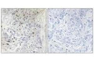 Immunohistochemistry analysis of paraffin-embedded human breast carcinoma tissue, using MAFF antibody. (MafF antibody)