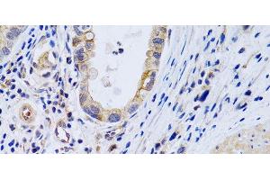 Immunohistochemistry of paraffin-embedded Human gastric cancer using PTGIR Polyclonal Antibody at dilution of 1:200 (40x lens). (Prostacyclin Receptor antibody)