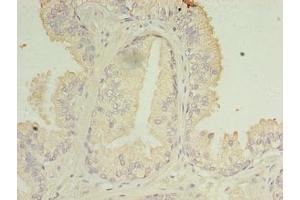 Immunohistochemistry of paraffin-embedded human prostate cancer using ABIN7166819 at dilution of 1:100 (C11ORF45 antibody  (AA 23-145))