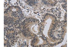 The image on the left is immunohistochemistry of paraffin-embedded Human colon cancer tissue using ABIN7189784(ALX4 Antibody) at dilution 1/20, on the right is treated with synthetic peptide. (ALX4 antibody)