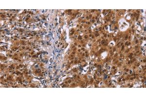 Immunohistochemistry of paraffin-embedded Human gastic cancer using CBX3 Polyclonal Antibody at dilution of 1:40 (CBX3 antibody)