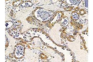 ABIN7093923 and ABIN7097967 at 1/100 staining human ovarian cancer by IHC-P. (NCS1 antibody  (C-Term))