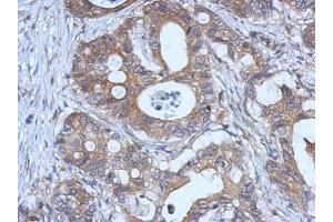 IHC-P Image Immunohistochemical analysis of paraffin-embedded human gastric cancer, using GPX2, antibody at 1:500 dilution. (Glutathione Peroxidase 2 antibody  (C-Term))