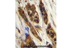 SNR27 Antibody (Center) immunohistochemistry analysis in formalin fixed and paraffin embedded human bladder carcinoma followed by peroxidase conjugation of the secondary antibody and DAB staining. (SNRNP27 antibody  (Middle Region))