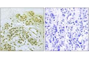 Immunohistochemistry analysis of paraffin-embedded human breast carcinoma, using IkappaB-alpha (Phospho-Tyr42) Antibody. (NFKBIA antibody  (pTyr42))