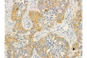 SDF4 Mouse Monoclonal Antibody at 1/100 staining human lung cancer by IHC-P.