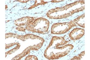 Formalin-fixed, paraffin-embedded human Prostate Carcinoma stained with YBX1 Mouse Monoclonal Antibody (YBX1/2430) (YBX1 antibody)