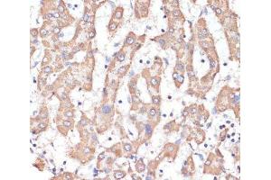 Immunohistochemistry of paraffin-embedded Human liver cancer using ATP5A1 Polyclonal Antibody at dilution of 1:100 (40x lens). (ATP5A1 antibody)
