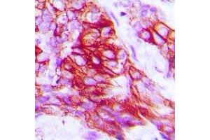 Immunohistochemical analysis of Syntaxin 1A (pS14) staining in human prostate cancer formalin fixed paraffin embedded tissue section. (STX1A antibody  (N-Term, pSer14))