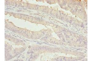 Immunohistochemistry of paraffin-embedded human endometrial cancer using ABIN7145239 at dilution of 1:100 (BBS2 antibody  (AA 1-96))