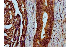 IHC image of ABIN7158674 diluted at 1:300 and staining in paraffin-embedded human colon cancer performed on a Leica BondTM system. (LYRM4 antibody  (AA 1-91))