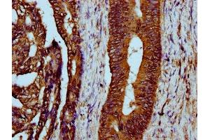 IHC image of ABIN7158674 diluted at 1:300 and staining in paraffin-embedded human colon cancer performed on a Leica BondTM system.