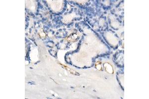 Immunohistochemistry of paraffin-embedded human thyroid cancer using eNOS Rabbit mAb (ABIN7268920) at dilution of 1:200 (40x lens). (ENOS antibody)