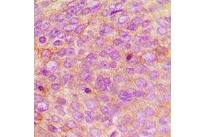 Immunohistochemical analysis of Defensin alpha 1 staining in human breast cancer formalin fixed paraffin embedded tissue section. (alpha Defensin 1 antibody  (Center))