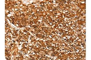 The image on the left is immunohistochemistry of paraffin-embedded Human prostate cancer tissue using ABIN7192401(SLC16A3 Antibody) at dilution 1/30, on the right is treated with synthetic peptide. (SLC16A3 antibody)