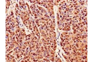 Immunohistochemistry of paraffin-embedded human ovarian cancer using ABIN7162945 at dilution of 1:100 (Peroxiredoxin 6 antibody  (AA 87-224))
