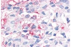 Immunohistochemistry (Formalin/PFA-fixed paraffin-embedded sections) of human breast cancer tissue with ESRRG polyclonal antibody . (ESRRG antibody  (N-Term))