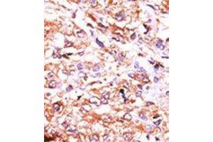 Formalin-fixed and paraffin-embedded human cancer tissue reacted with the primary antibody, which was peroxidase-conjugated to the secondary antibody, followed by AEC staining. (GUCY1A2 antibody  (N-Term))