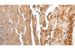 Immunohistochemistry of paraffin-embedded Human cervical cancer using NPY1R Polyclonal Antibody at dilution of 1:30