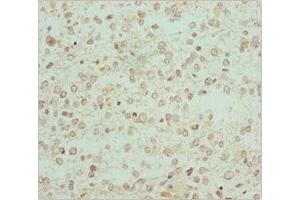 Immunohistochemistry of paraffin-embedded human glioma using ABIN7167743 at dilution of 1:100 (RCN2 antibody  (AA 23-180))