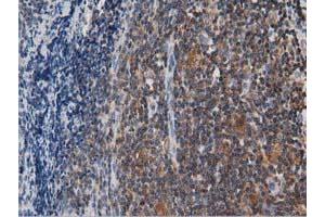 Immunohistochemical staining of paraffin-embedded Human lymphoma tissue using anti-ARHGAP25 mouse monoclonal antibody.