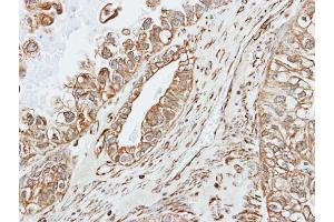 IHC-P Image Immunohistochemical analysis of paraffin-embedded human ovarian cancer, using alpha amylase 2A(pancreatic), antibody at 1:500 dilution. (AMY2A antibody)
